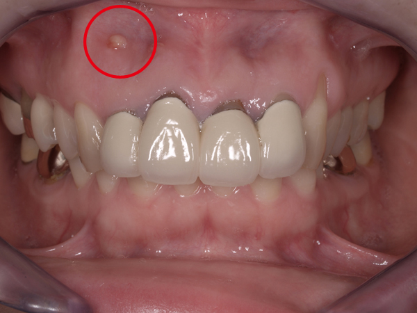 1.術前｜前歯から2番目の赤丸 精密根管治療。前歯5歯のオールセラミッククラウンと1歯ポーセレン･ラミネートベニア。
