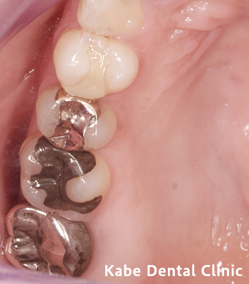 奥歯3本の詰め物をe-maxに変更した方の治療前