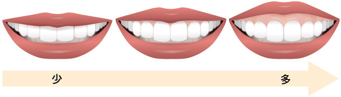 歯茎の露出量（スマイルライン）