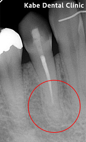 歯茎に黒い影が見られていた方の治療後
