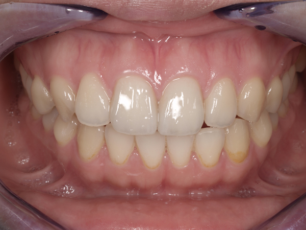 2.術後｜32才 女性 審美精密歯科 オールセラミッククラウン。前歯2歯の治療です。