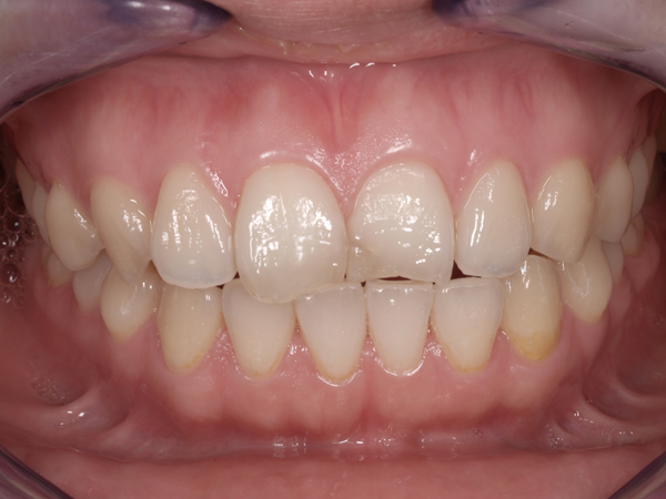 1.術前｜ 32才 女性 審美精密歯科 オールセラミッククラウン。前歯2歯の治療です。