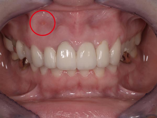 2.術後｜前歯から2番目の赤丸 精密根管治療。前歯5歯のオールセラミッククラウンと1歯ポーセレン･ラミネートベニア。