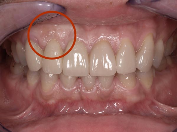 2.術後｜3歯のオールセラミッククラウン 3歯のポーセレン･ラミネートベニア。赤丸は元々歯がなく、歯茎が凹んでいるところに歯周形成外科手術を行いました。