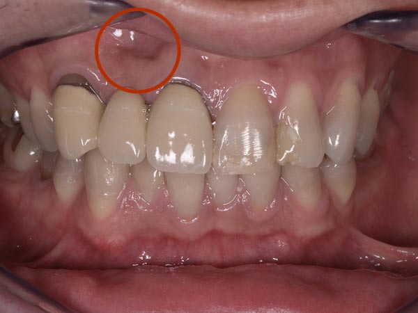 1.術前｜3歯のオールセラミッククラウン 3歯のポーセレン･ラミネートベニア。赤丸は元々歯がなく、歯茎が凹んでいるところに歯周形成外科手術を行いました。
