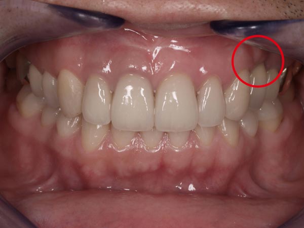 2.術後｜左上4番の欠損した部分にインプラント治療を行いました。前歯のオールセラミッククラウンを含め全体的な治療を行っています。