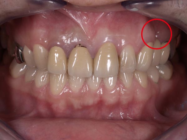 1.術前｜左上4番の欠損した部分にインプラント治療を行いました。前歯のオールセラミッククラウンを含め全体的な治療を行っています。