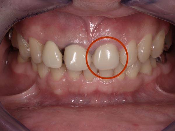 1.術前｜左上1番の前歯は根が割れていて、どうしても残せなかったため、インプラント治療を行いました。3歯のオールセラミッククラウン。1歯のポーセレン･ラミネートベニア。
