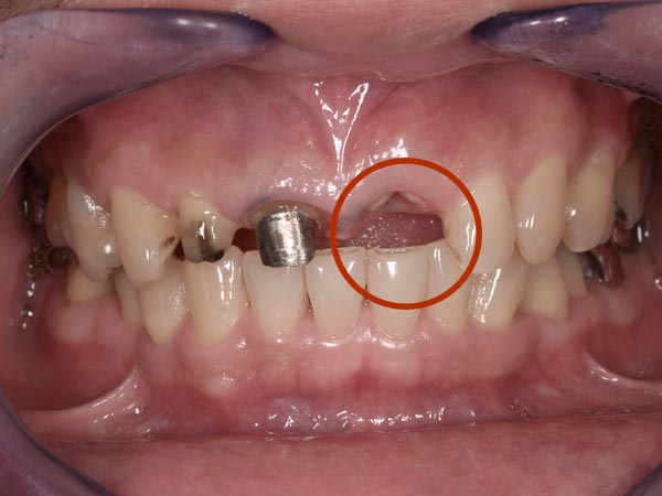 2.術中｜左上1番の前歯は根が割れていて、どうしても残せなかったため、インプラント治療を行いました。3歯のオールセラミッククラウン。1歯のポーセレン･ラミネートベニア。