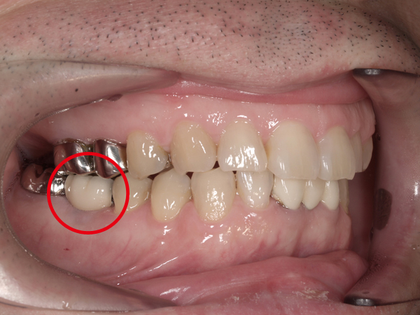 4.術後｜赤丸：右下奥歯を審美精密インプラント