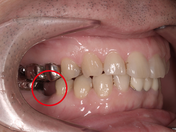 3.術前｜赤丸：右下奥歯を審美精密インプラント