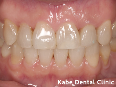 ダイレクトボンディングで前歯の質感と横の歯の虫歯を治療した方の治療後