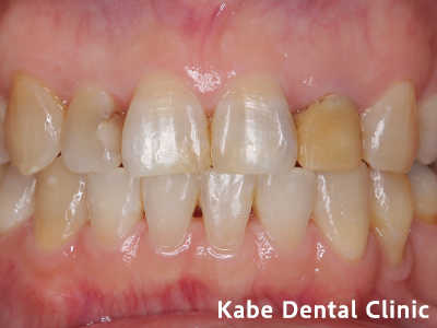 ダイレクトボンディングで前歯の質感と横の歯の虫歯を治療した方の治療前