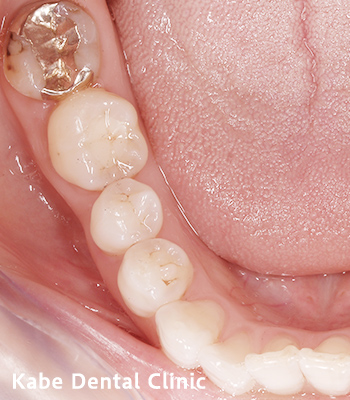奥歯の1部分のみe-maxに変更した方の治療後