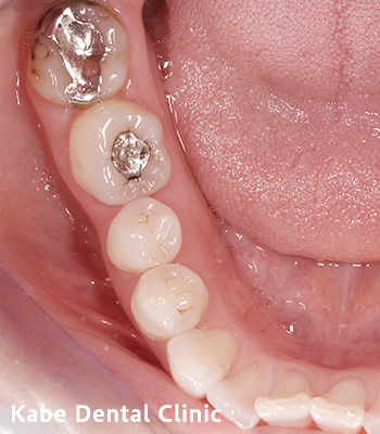 奥歯の1部分のみe-maxに変更した方の治療前