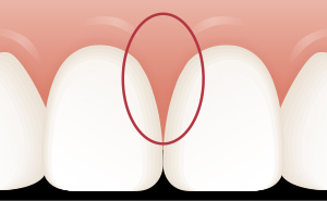 歯と歯の間の歯茎（歯間乳頭）