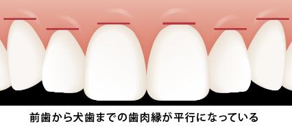 美しく見える歯茎の状態