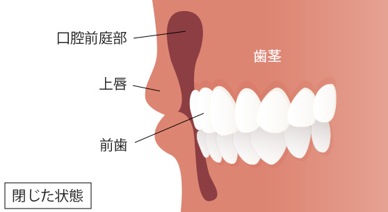上口唇の縁から上の歯列と頬の粘膜の空間となる頂点までの距離が通常よりも長いこと
