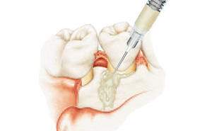 治療法を組み合わせ、抜歯を宣告された歯も可能な限り保存