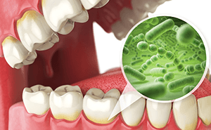 歯周病を併発している虫歯