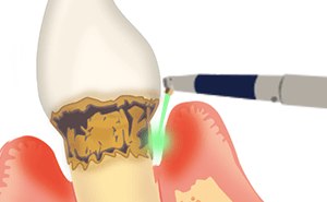 レーザーなら歯茎を切開せずに治療可能