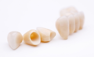 歯周病の進行を促進するインプラント歯周炎