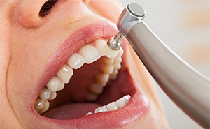 歯科専用の機械で虫歯・歯周病の原因菌を、時間をかけて丁寧に除去