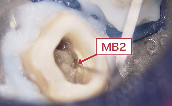 マイクロスコープで副根管（MB2）を発見