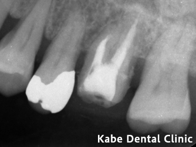 虫歯と歯周病を併発していた方の治療前