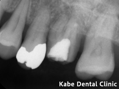 虫歯と歯周病を併発していた方の治療前