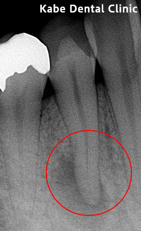 歯茎に黒い影が見られていた方の治療前