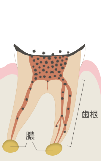 C4(歯根に達した虫歯)