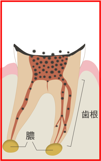 C4(歯根に達した虫歯)