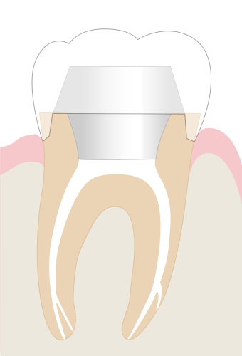 抜髄を行い詰め物をし、フタをして密閉した歯の状態イメージ